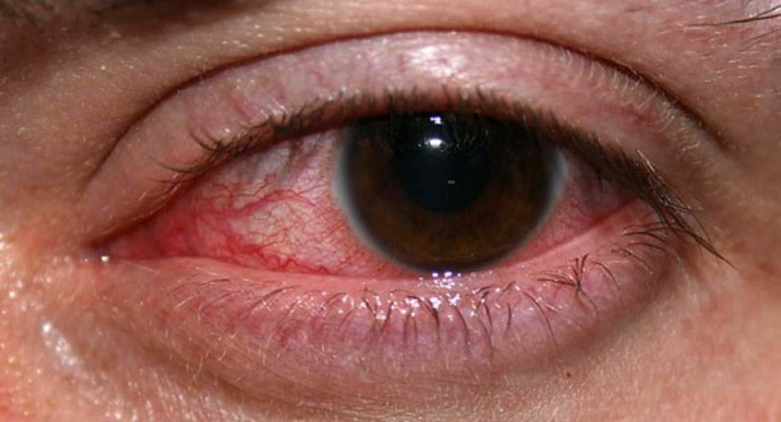 What is the fungal eye infection Fungal Keratitis?