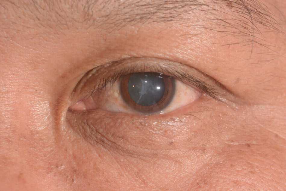 Cataracts