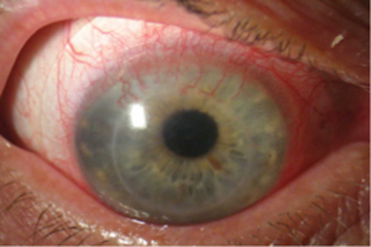 Corneal Neovascularisation | Eye Blood Vessel Growth