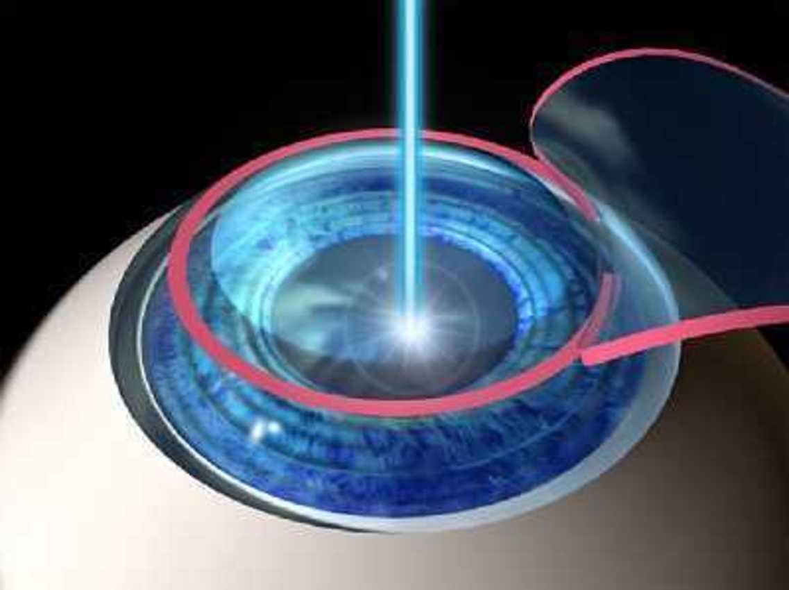 Contact Lenses vs Laser Eye Surgery
