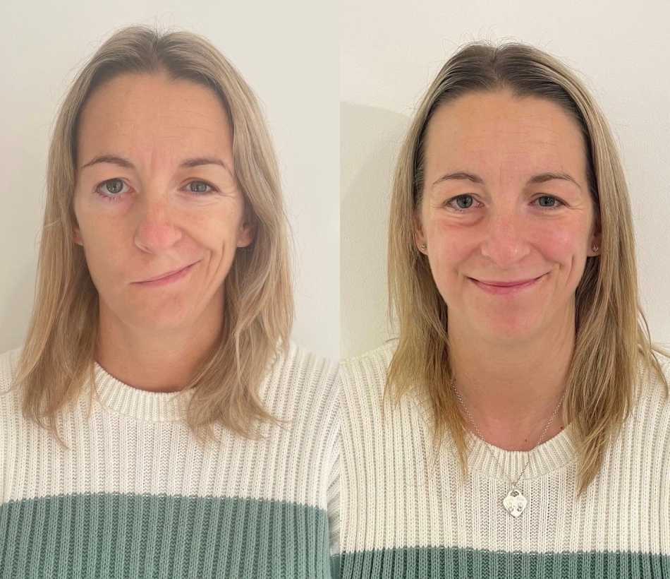 What is Bell's Palsy? Causes, Symptoms and Treatment
