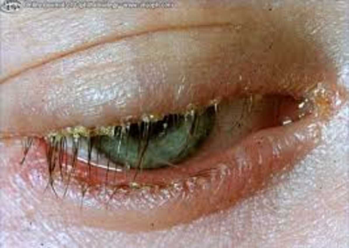 What is Blepharitis? Swollen Eyelid inflammation causes & treatment