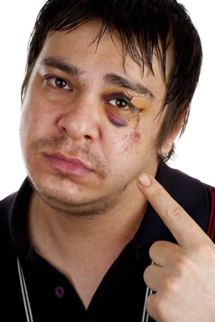 What is a Black Eye?