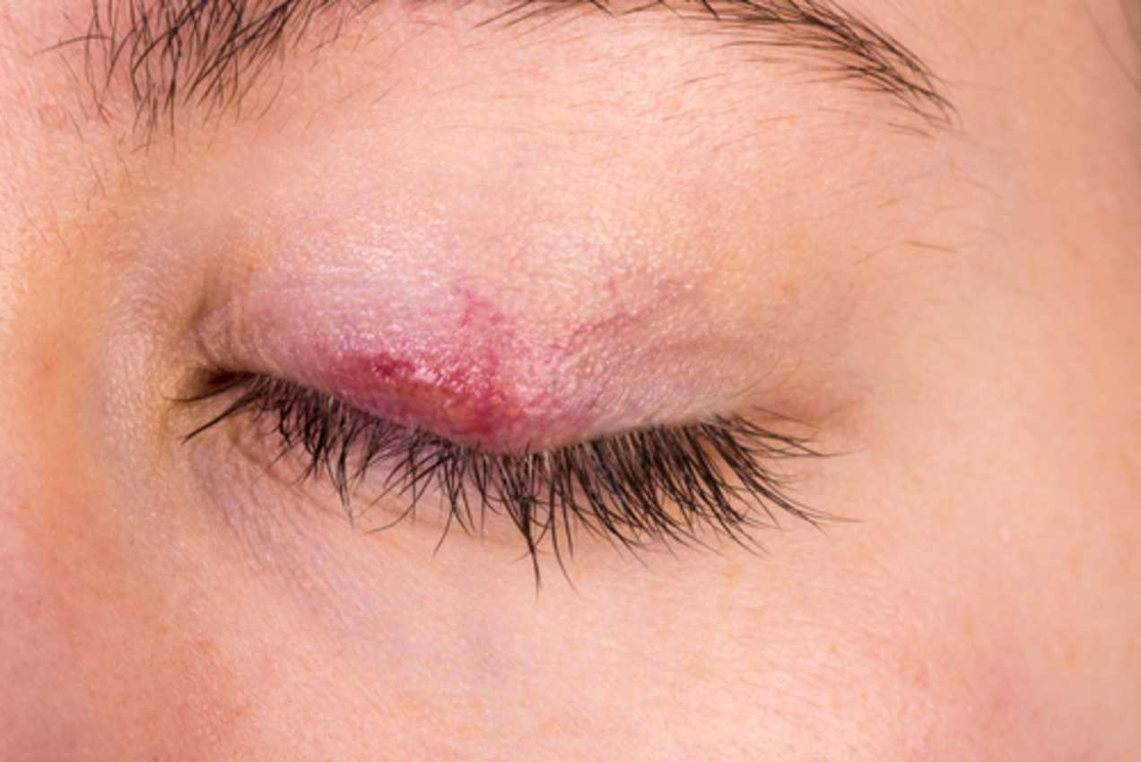 What is a Chalazion?