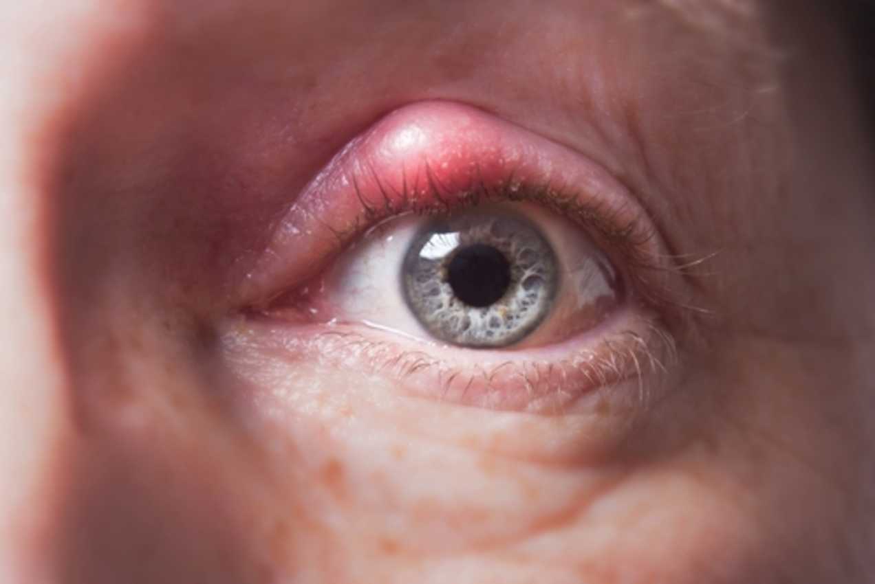 What is a Stye? symptoms and treatment