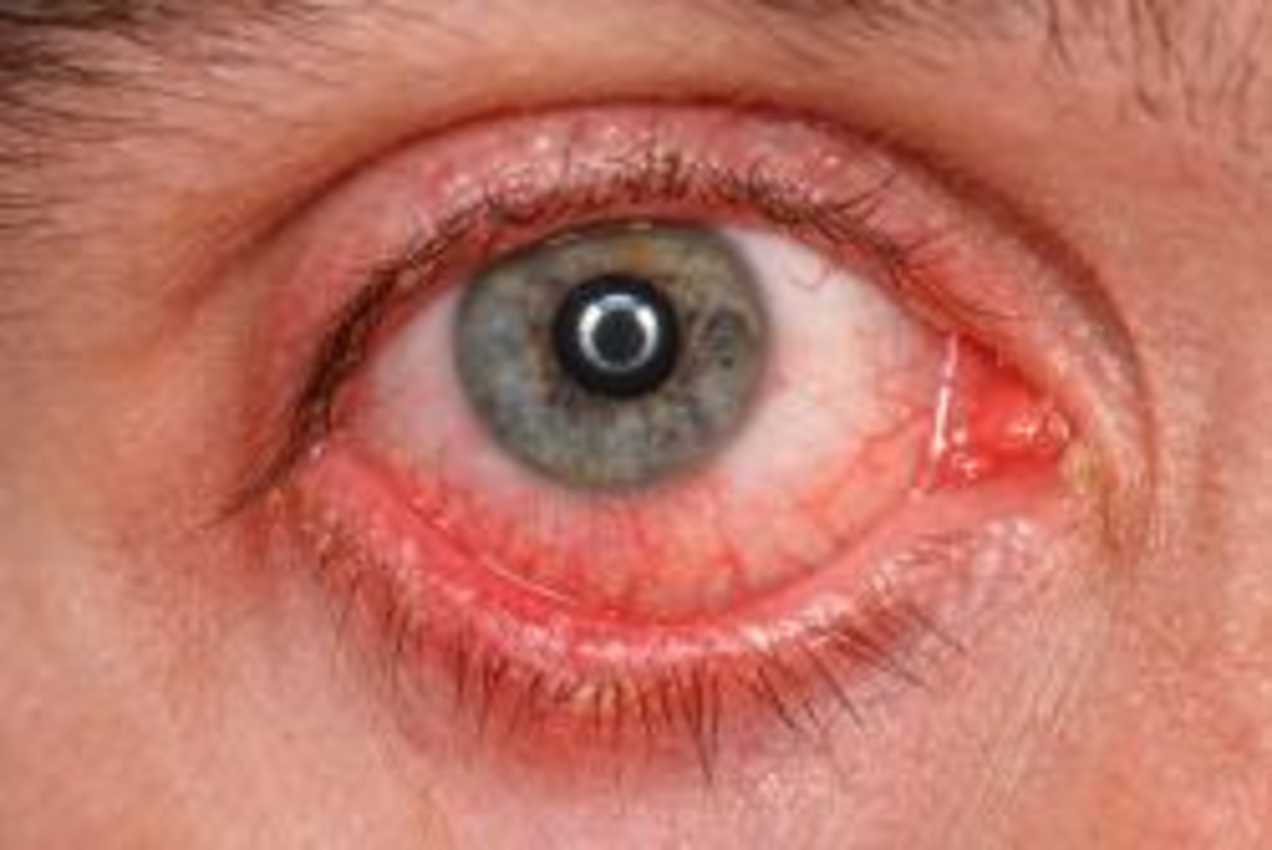 What is Conjunctivitis? Causes, Symptoms & treatment