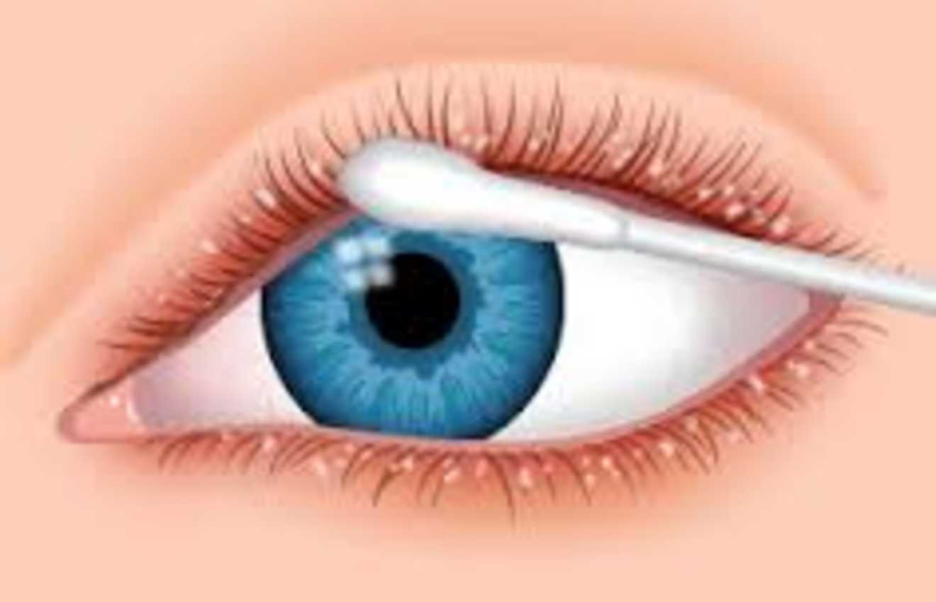 What is Meibomian gland dysfunction or mgd?