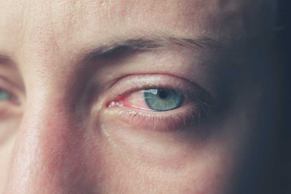 What causes bloodshot eyes?