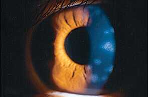 Eye shingles Explained