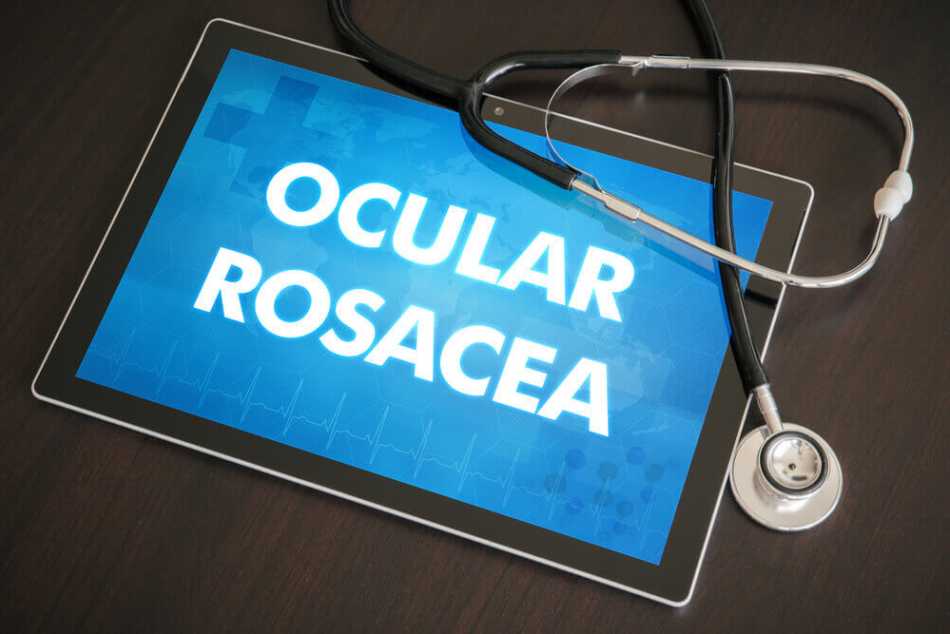 Ocular Rosacea: More Than Meets the Eye