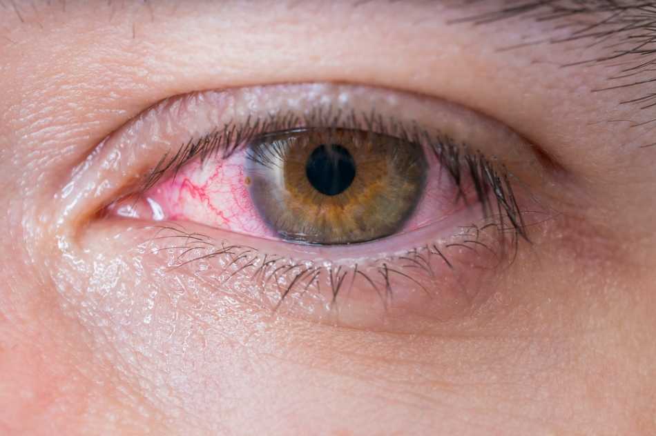 How to tell if I have an Eye Infection
